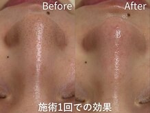 セレソル(CERESOL)/私の魔法の毛穴洗浄術