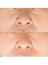 キレイシェア バイ プリンセスローズ静岡駅店(KIREI SHARE)/肌のお悩み