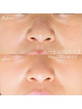 キレイシェア バイ プリンセスローズ静岡駅店(KIREI SHARE)/肌のお悩み