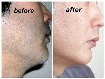 ベルマタン(belle matin)/ヒゲゼロで肌も綺麗に