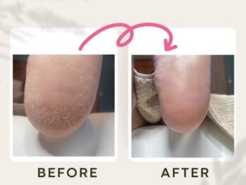 ドクターネイル爪革命 恵庭店/角質ケア