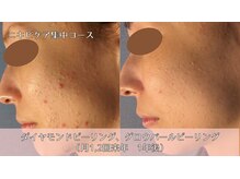 オーシャンブルー 時津店(OCEAN BLUE)/ニキビケア集中コース