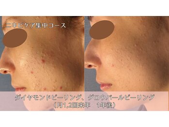 オーシャンブルー 時津店(OCEAN BLUE)/ニキビケア集中コース