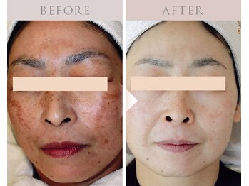 ジェニックサロン グランドギンザ ひたちなか(GENIC SALON GRAND GINZA)/本気の肌改善