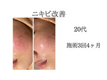 シャルナ(charna)/赤み/ニキビ改善