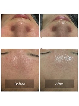 マヴィ(Mavie)/ハーブピーリング　Before After