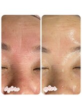 レティシア(Leticia)/◇エステ版ダーマ水光注入◇