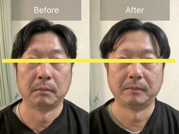 わたしのネイルとよもぎ蒸し/人中短縮◎のっぺりをシャキッと