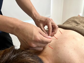 上楽スポーツ鍼灸院/鍼灸での痛みを改善
