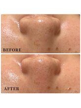 エース(ACE.)/毛穴汚れごっそり！！