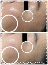 ラン(Ran)/ホワイトスノーピールで肌改善へ