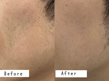 セルフメイド 高崎店(SELFMADE)/ヒゲ脱毛10回ビフォーアフター