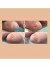 副爪2箇所（小指の爪横にある爪ではないモノ）【魚の目までケア】　¥6,600