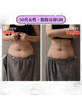 グランディールアン(GRANDIR UN)/脂肪冷却～3ヶ月経過