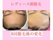 グロワール(gloire)/レディース顔脱毛BeforeAfter