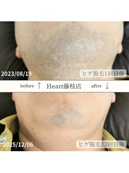 ハート 藤枝店(Heart)/メンズひげ脱毛