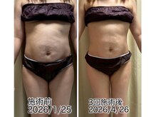 クールスパ(COOL SPA)/30代女性お腹症例