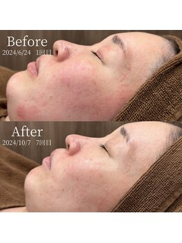 アマリリス(Amaryllis)/ハーブピーリング before/after