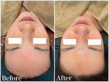 サロンドフェイス(Salon de Faith)/【ハーブピーリング】4回施術♪