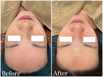 サロンドフェイス(Salon de Faith)/【ハーブピーリング】4回施術♪