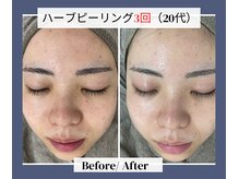 グリッター ショウナン(glitter.SHONAN)の雰囲気（別人レベルに変身!!ハーブの力で肌悩み0へ★）