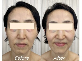 ドクターボディ 新宿店(Dr.Body)/【たるみ/顔の長さ/立体感50代】