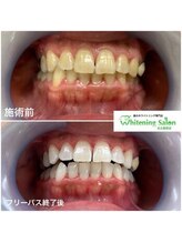 ホワイトニングサロン 名古屋駅店/【ホワイトニング施術例】