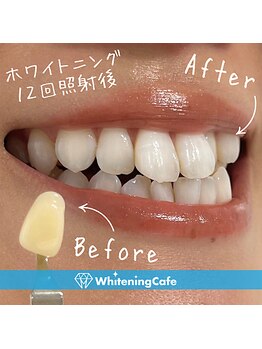 ホワイトニングカフェ 池袋東口店/ホワイトニングビフォーアフター