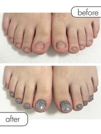 ◆フット深爪矯正◆