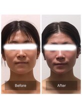 ヒール(heal)/インディバフェイシャル３回