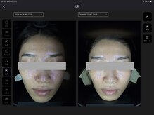 ペイジ(peige)/【peige】AI肌診断