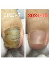 プラスキュア 用賀店(+CURE)/肥厚爪 変形爪 副爪 60分6600～