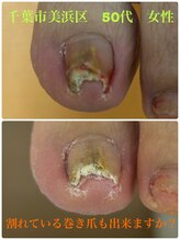 巻き爪じゅん 千葉駅前店/割れた巻き爪もできますか？