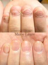 マリーロール 淀屋橋本店(Marie Laure)/自爪育成/深爪矯正/ネイルケア