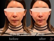 チョコバリ 新宿店(chocobari)/小顔×リフトアップ(美容鍼)20代