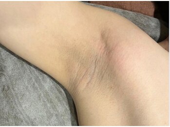 ヨハク(YOHAKU)/30代前半　男性　10回施術after