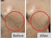 エマクラン(emmaclan)/