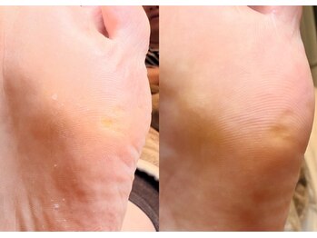 ロッタ(Lotta)/ foot.