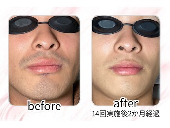 イチキュービー 仙台駅前東口店(19B)/男性のひげ脱毛の経過