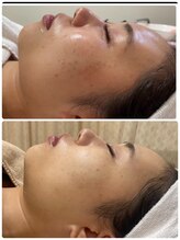 ビズビズ 天王寺店(bisebise)/ニキビ/毛穴開き黒ずみ角栓詰り