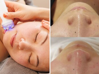 ミニ(MINI)/ハイパーナイフEX小顔と毛穴洗浄