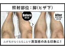 RBL イオンモール宮崎店/メンズ脱毛/ヒザ下3回目剃毛後