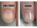 ◆育成◆お爪の経過写真