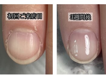 プレシャスハート 広島(Precious Heart)/◆育成◆お爪の経過写真