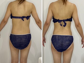 カプリス(CAPRiCE)/リンパドレナージュ