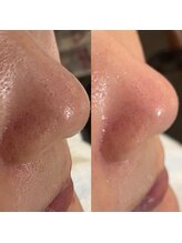 ミニョンプラス(Mignon+)/毛穴が変わると肌が変わる