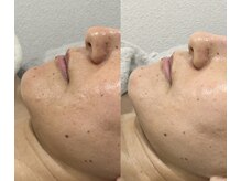 シエロ(Cielo)/ルヴィ剥けないハーブピーリング