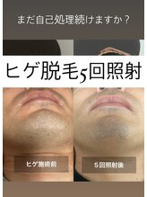 リリー(RILY)/【ビフォーアフター】