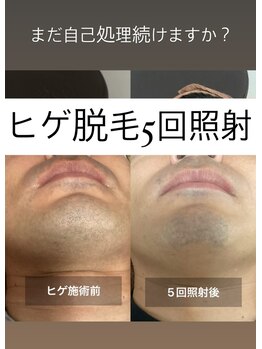 リリー(RILY)/【ビフォーアフター】