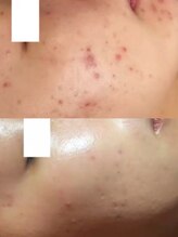 ダリアビューティー(Dahlia Beauty)/コモデックスbefore after